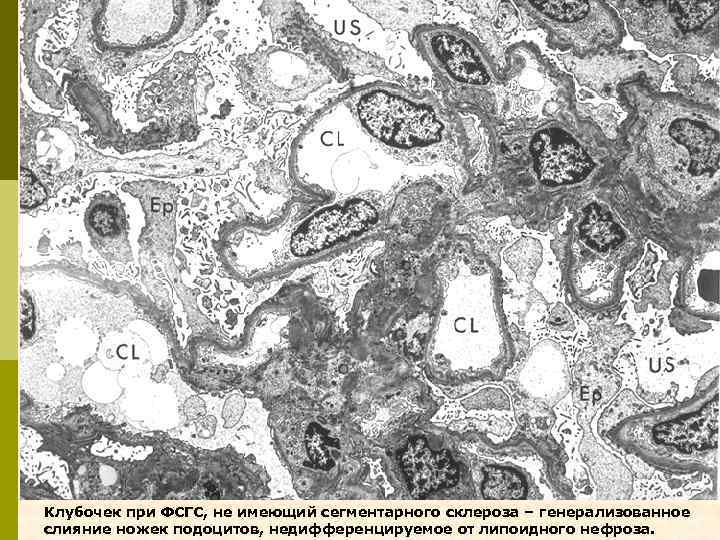 Клубочек при ФСГС, не имеющий сегментарного склероза – генерализованное слияние ножек подоцитов, недифференцируемое от