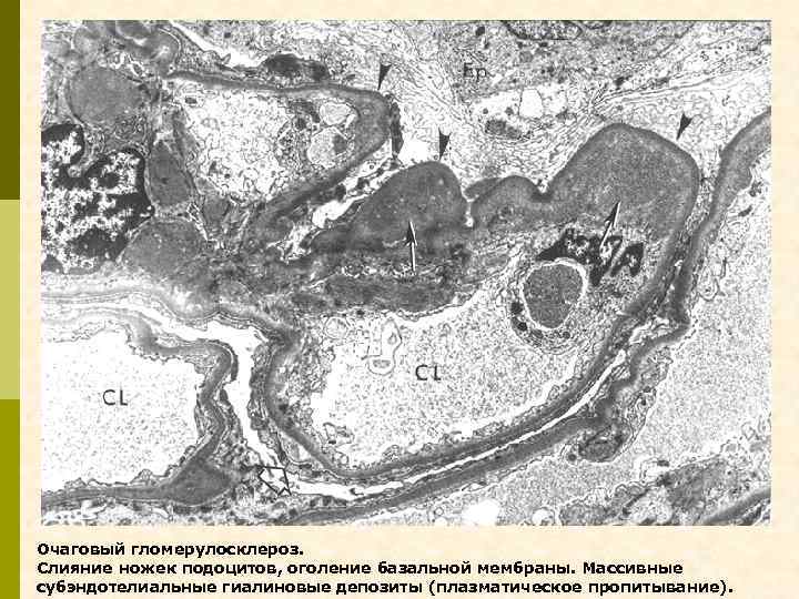 Очаговый гломерулосклероз. Слияние ножек подоцитов, оголение базальной мембраны. Массивные субэндотелиальные гиалиновые депозиты (плазматическое пропитывание).