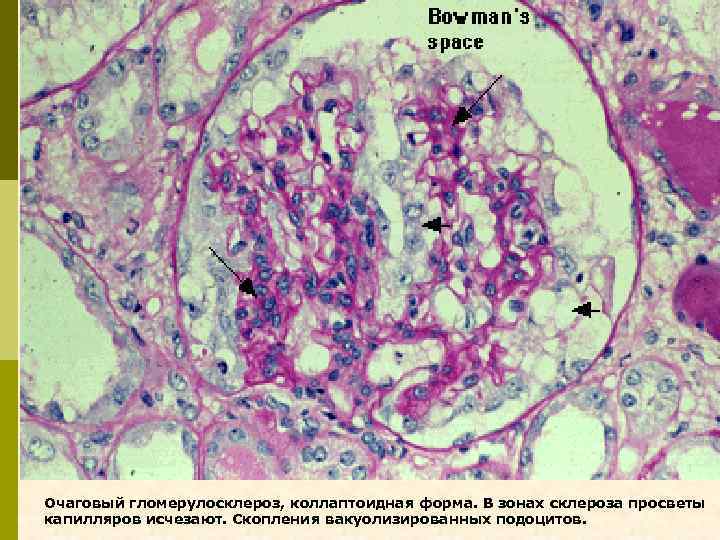 Очаговый гломерулосклероз, коллаптоидная форма. В зонах склероза просветы капилляров исчезают. Скопления вакуолизированных подоцитов. 