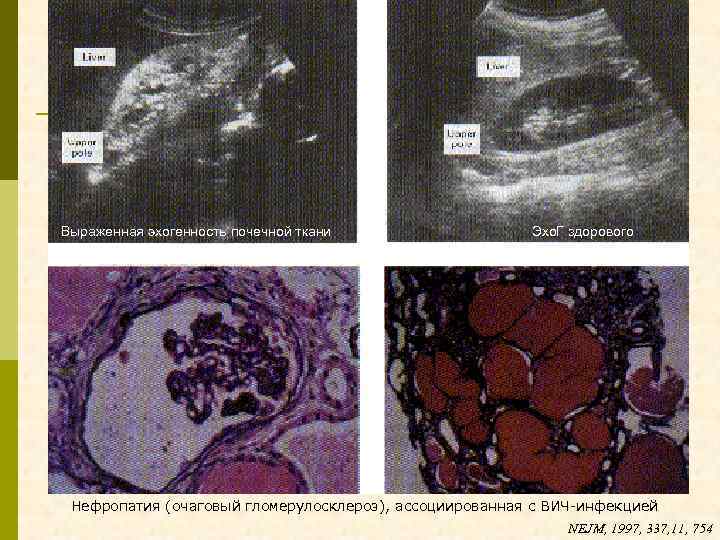 Выраженная эхогенность почечной ткани Эхо. Г здорового человека Нефропатия (очаговый гломерулосклероз), ассоциированная с ВИЧ-инфекцией