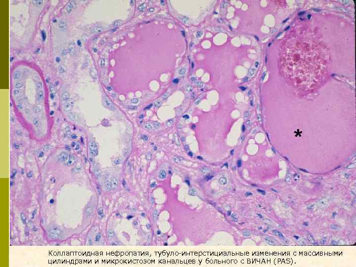 * Коллаптоидная нефропатия, тубуло-интерстициальные изменения с массивными цилиндрами и микрокистозом канальцев у больного с