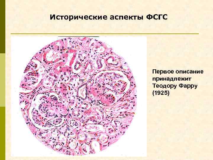 Исторические аспекты ФСГС Первое описание принадлежит Теодору Фарру (1925) 