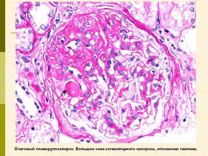 Очаговый гломерулосклероз. Большая зона сегментарного склероза, отложения гиалина. 
