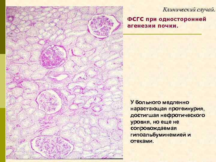 Клинический случай. ФСГС при односторонней агенезии почки. У больного медленно нарастающая протеинурия, достигшая нефротического