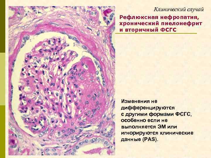 Клинический случай Рефлюксная нефропатия, хронический пиелонефрит и вторичный ФСГС Изменения не дифференцируются с другими