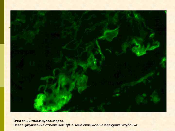 Очаговый гломерулосклероз. Неспецифические отложения Ig. М в зоне склероза на верхушке клубочка. 