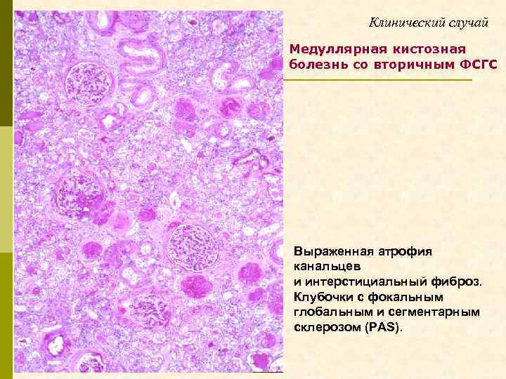 Медуллярный рак рекомендации. Гломерулосклероз гистология. Фокально-сегментарный гломерулосклероз. Диффузный гломерулосклероз. Фокально-сегментарный гломерулосклероз гистология.