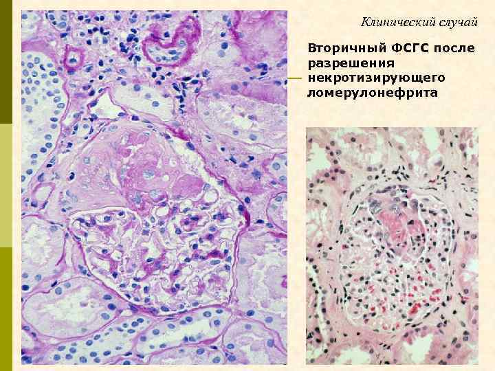 Клинический случай Вторичный ФСГС после разрешения некротизирующего ломерулонефрита 