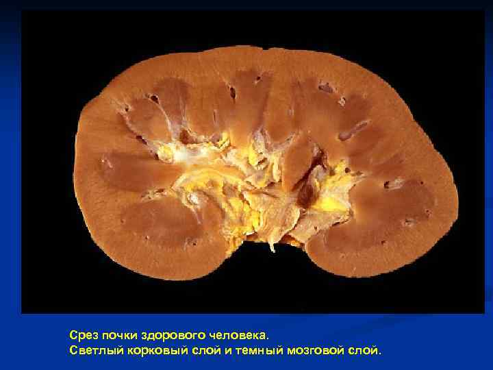 Срез почки здорового человека. Светлый корковый слой и темный мозговой слой. 