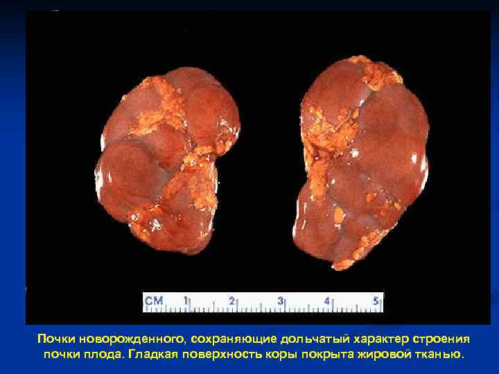 Почки новорожденного, сохраняющие дольчатый характер строения почки плода. Гладкая поверхность коры покрыта жировой тканью.