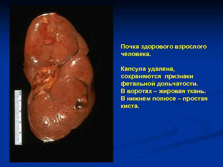 Почка здорового взрослого человека. Капсула удалена, сохраняются признаки фетальной дольчатости. В воротах – жировая