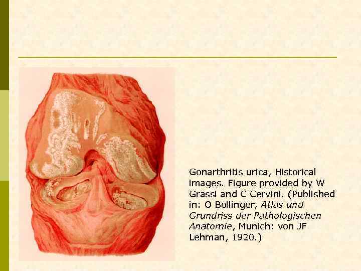 Gonarthritis urica, Historical images. Figure provided by W Grassi and C Cervini. (Published in: