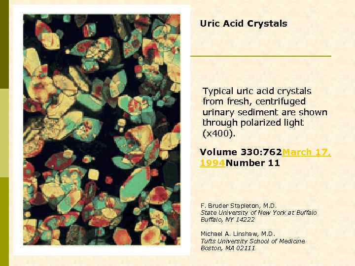 Uric Acid Crystals Typical uric acid crystals from fresh, centrifuged urinary sediment are shown