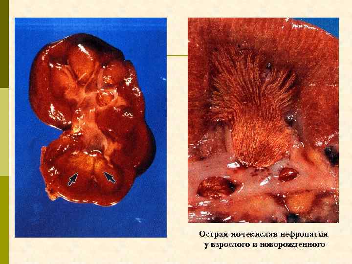 Острая мочекислая нефропатия у взрослого и новорожденного 