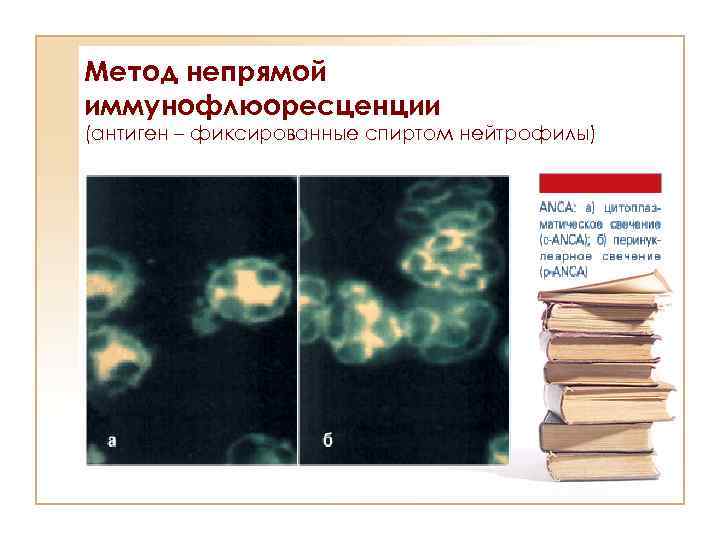 Метод непрямой иммунофлюоресценции (антиген – фиксированные спиртом нейтрофилы) Типы свечения АНЦА 