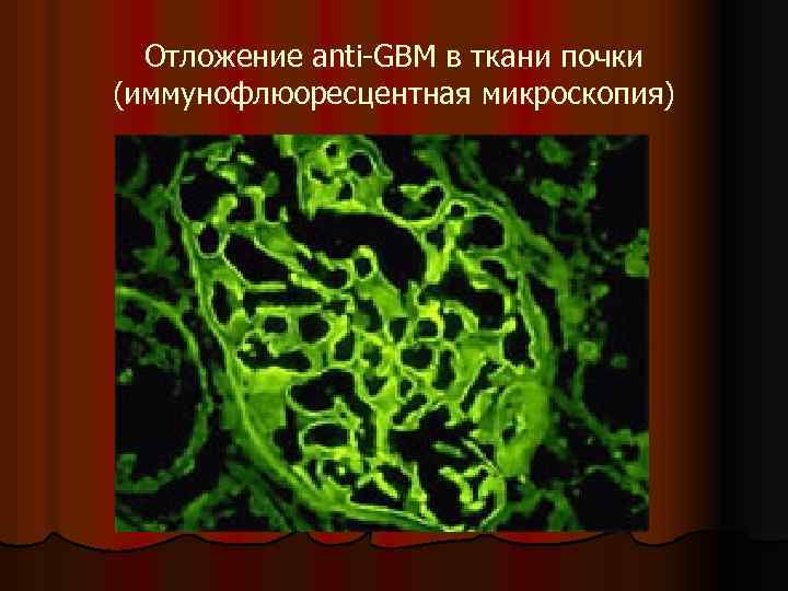 Отложение anti-GBM в ткани почки (иммунофлюоресцентная микроскопия) 