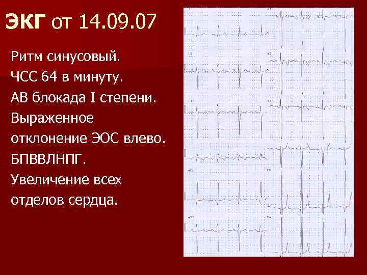 ЭКГ от 14. 09. 07 Ритм синусовый. ЧСС 64 в минуту. АВ блокада I