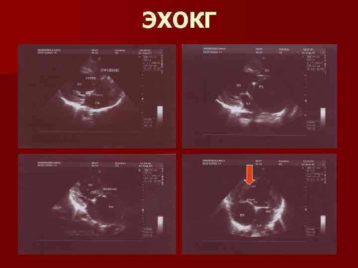 ЭХОКГ 