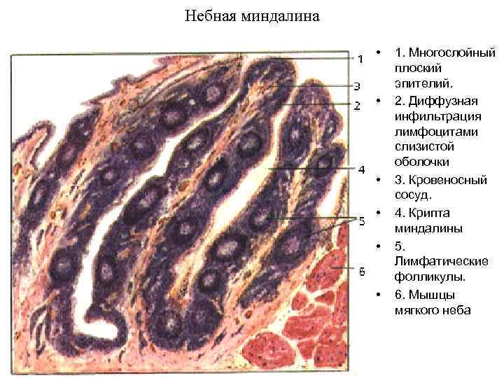 Небная миндалина • • • 1. Многослойный плоский эпителий. 2. Диффузная инфильтрация лимфоцитами слизистой