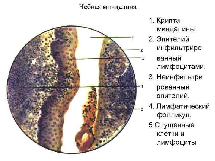 Небная миндалина 1. Крипта миндалины 2. Эпителий инфильтриро ванный лимфоцитами. 3. Неинфильтри рованный эпителий.