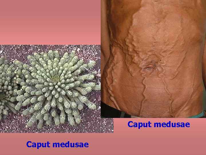 Caput medusae 