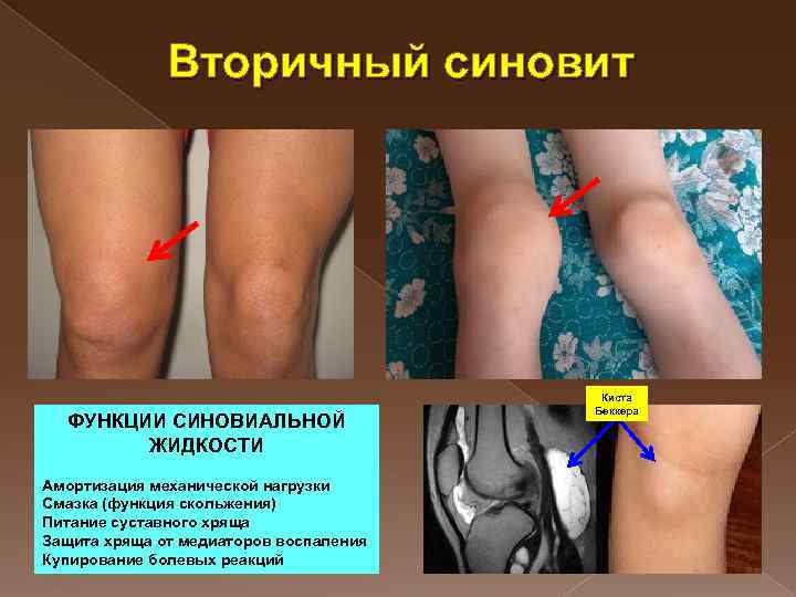 Вторичный синовит ФУНКЦИИ СИНОВИАЛЬНОЙ ЖИДКОСТИ Амортизация механической нагрузки Смазка (функция скольжения) Питание суставного хряща