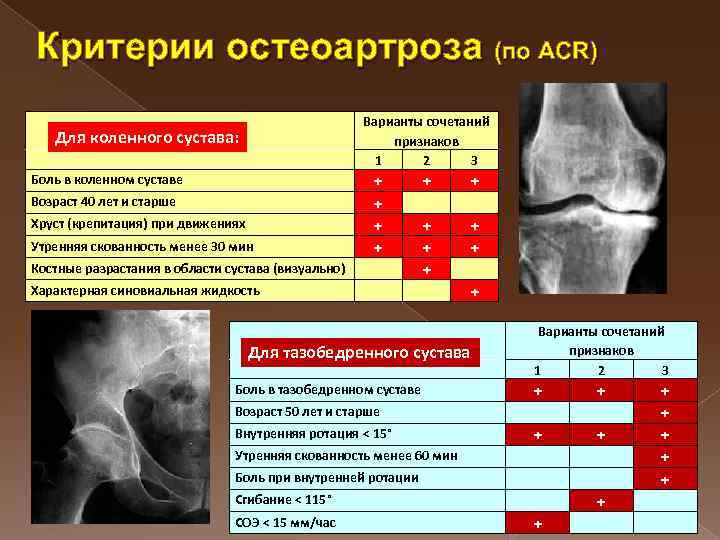 Диагноз доа суставов. Остеоартроз критерии. Остеоартроз коленных суставов критерии. Для остеоартроза характерны. Остеоартроз критерии ACR.