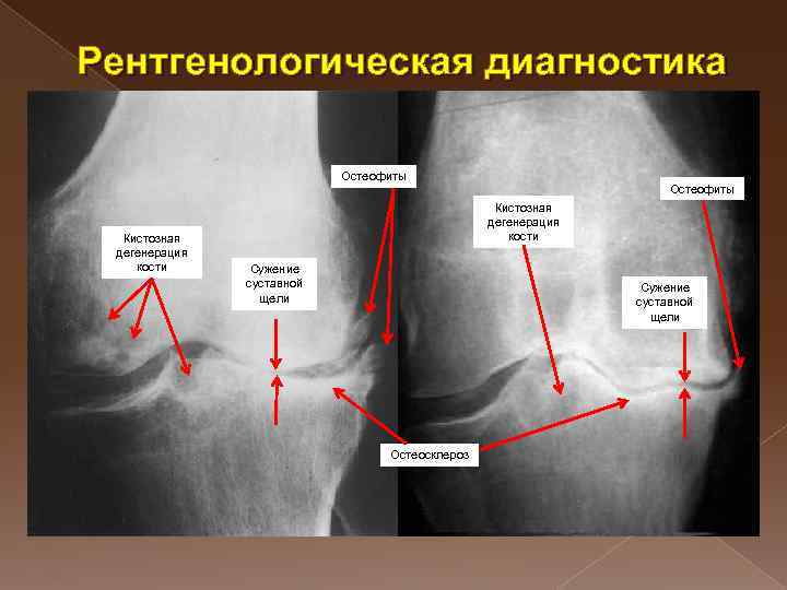 Рентгенологическая диагностика Остеофиты Кистозная дегенерация кости Сужение суставной щели Остеосклероз 