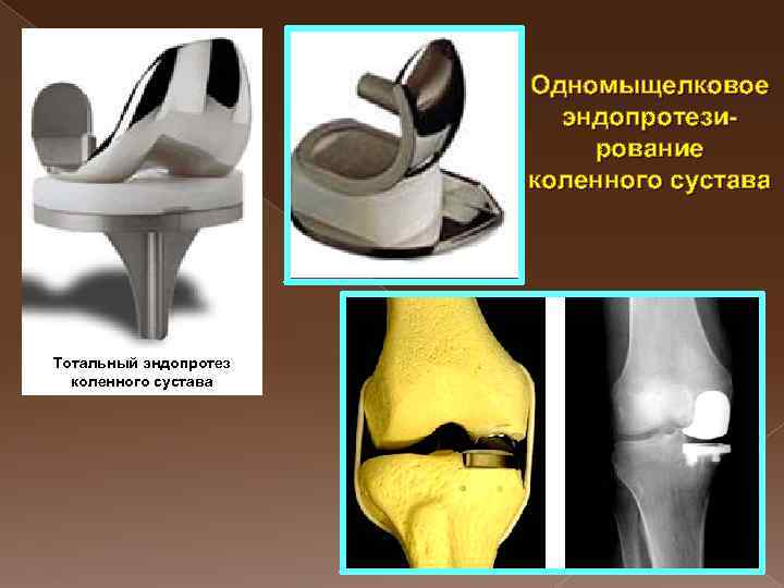 Одномыщелковое эндопротезирование коленного сустава Тотальный эндопротез коленного сустава 