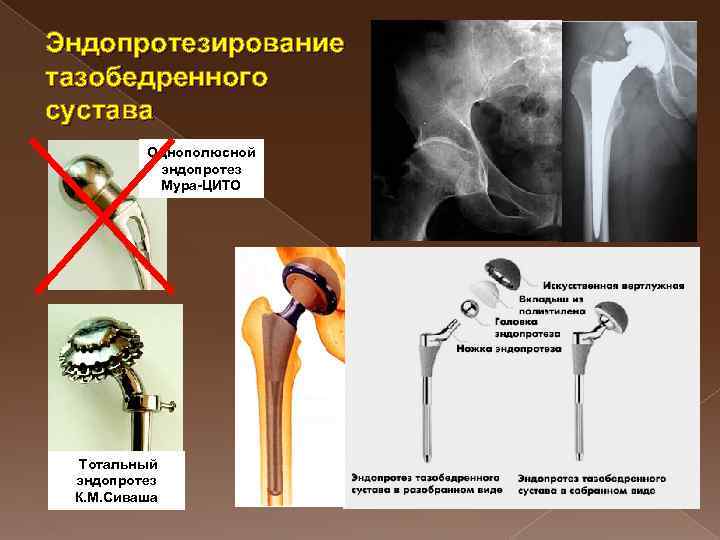 Эндопротез тазобедренного сустава отзывы. Тотальный бесцементный эндопротез тазобедренного сустава. Эндопротез Сиваша тазобедренного сустава.