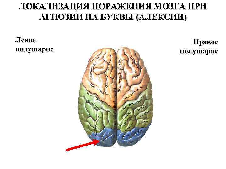 ЛОКАЛИЗАЦИЯ ПОРАЖЕНИЯ МОЗГА ПРИ АГНОЗИИ НА БУКВЫ (АЛЕКСИИ) Левое полушарие Правое полушарие 