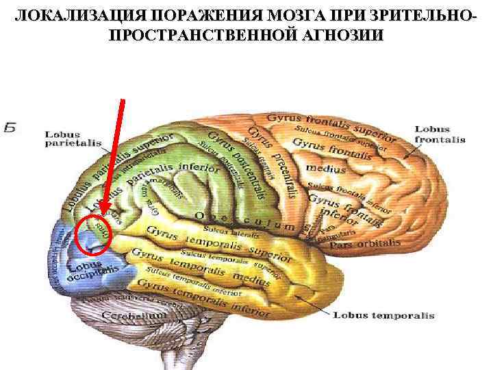 ЛОКАЛИЗАЦИЯ ПОРАЖЕНИЯ МОЗГА ПРИ ЗРИТЕЛЬНОПРОСТРАНСТВЕННОЙ АГНОЗИИ 