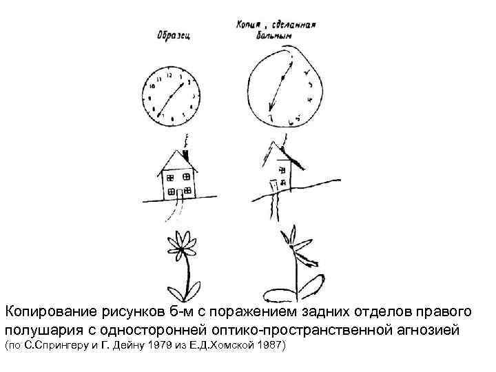 Копирование рисунков б-м с поражением задних отделов правого полушария с односторонней оптико-пространственной агнозией (по