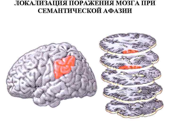 Эфферентная моторная афазия локализация