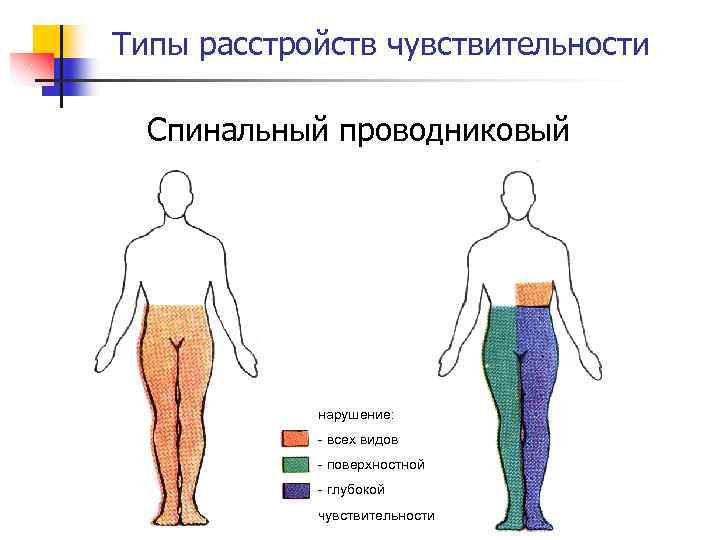 Типы расстройств чувствительности Спинальный проводниковый нарушение: - всех видов - поверхностной - глубокой чувствительности