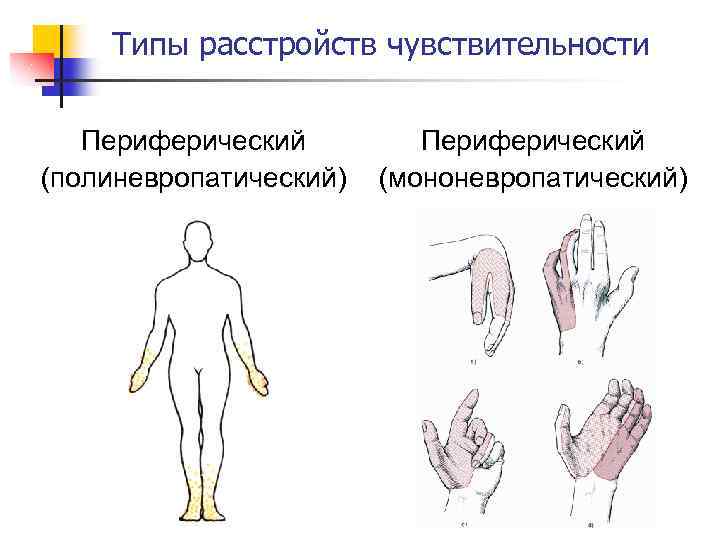 Типы расстройств чувствительности Периферический (полиневропатический) Периферический (мононевропатический) 