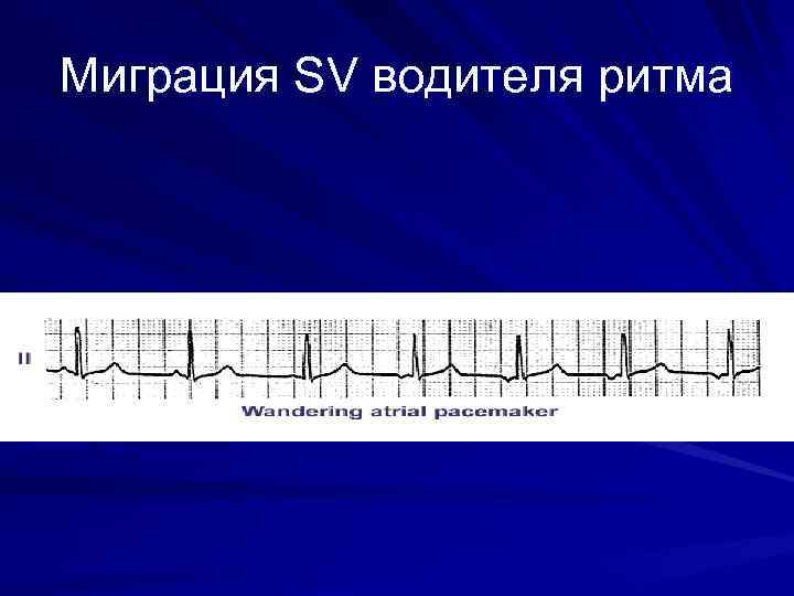 Миграция водителя ритма. Ритм синусовый миграция водителя ритма. Наджелудочковая миграция водителя ритма. Миграция водителя ритма брадикардия. Миграция водителя ритма с тахикардией.