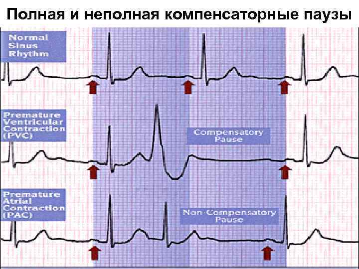 Полная и неполная компенсаторные паузы 