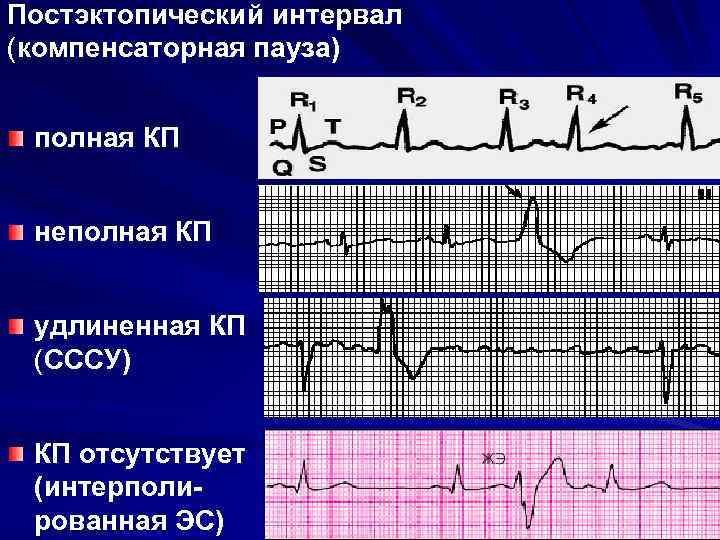 Постэктопический интервал (компенсаторная пауза) полная КП неполная КП удлиненная КП (СССУ) КП отсутствует (интерполированная