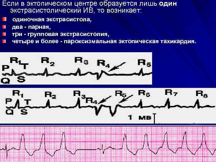 Если в эктопическом центре образуется лишь один экстрасистолический ИВ, то возникает: одиночная экстрасистола, два