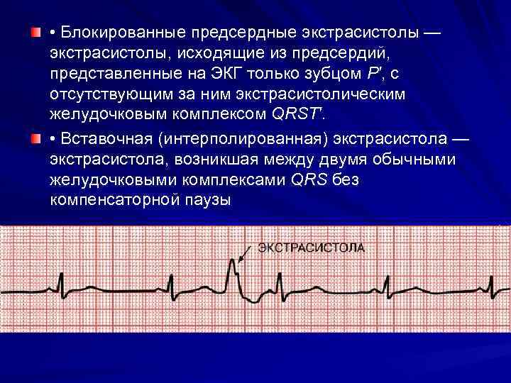  • Блокированные предсердные экстрасистолы — экстрасистолы, исходящие из предсердий, представленные на ЭКГ только