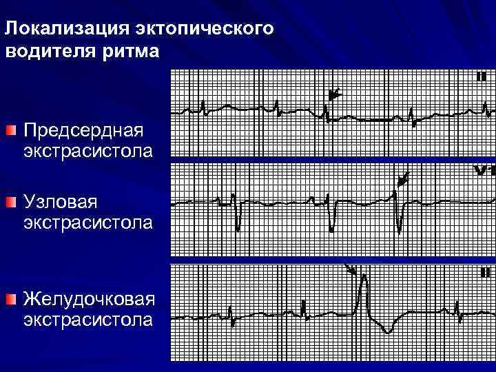 Узловой ритм сердца возникает когда роль водителя ритма берет на себя