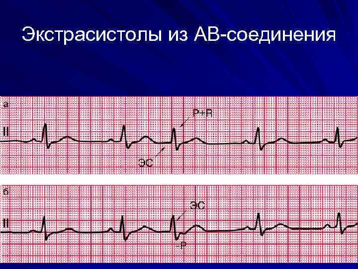 Экстрасистолы из АВ-соединения 