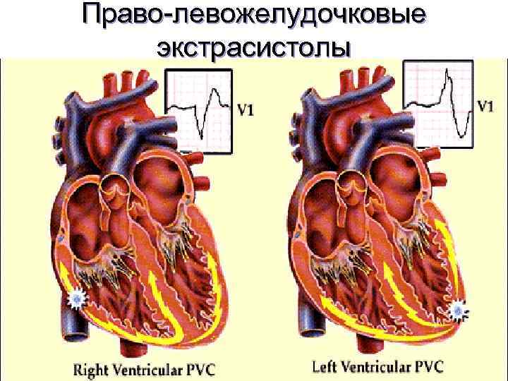 Право-левожелудочковые экстрасистолы 