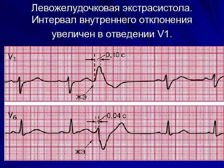 Левожелудочковая экстрасистола. Интервал внутреннего отклонения увеличен в отведении V 1. 