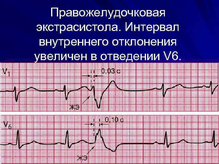 Правожелудочковая экстрасистола. Интервал внутреннего отклонения увеличен в отведении V 6. 