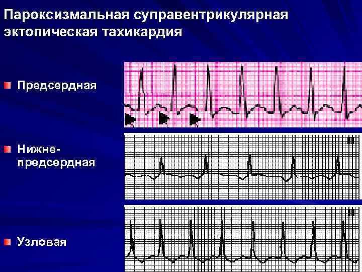 Экг картина при пароксизме суправентрикулярной тахикардии имеет вид