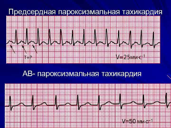 Предсердная пароксизмальная тахикардия АВ- пароксизмальная тахикардия 