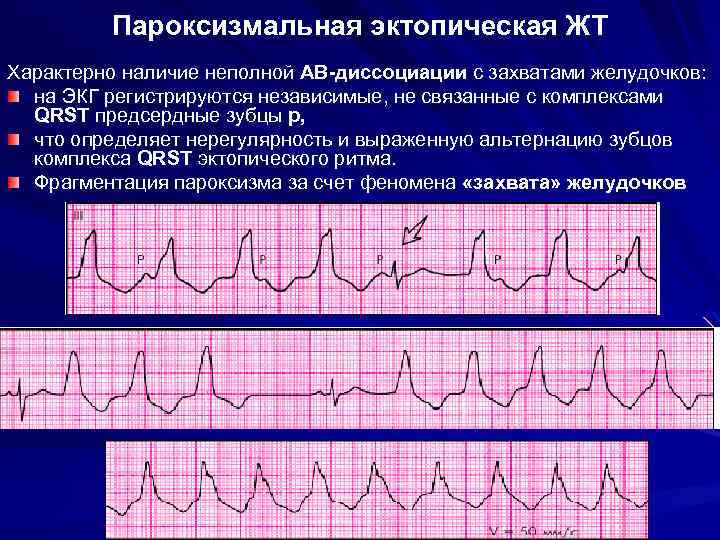 Эктопический ритм. АВ диссоциация при желудочковой тахикардии. Изоритмическая АВ диссоциация на ЭКГ. Пароксизмальная брадикардия ЭКГ. Предсердно-желудочковая диссоциация на ЭКГ.