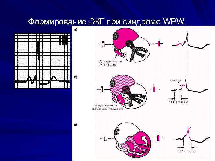 Wpw синдром на экг картинки